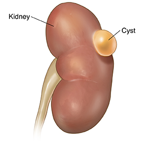 Ảnh 2 của Kidney cyst