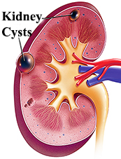 Ảnh 3 của Kidney cyst