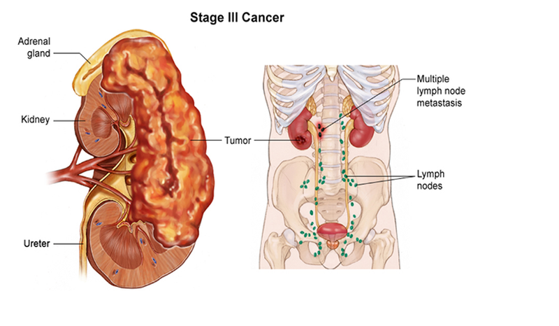 Ảnh 4 của Kidney cancer