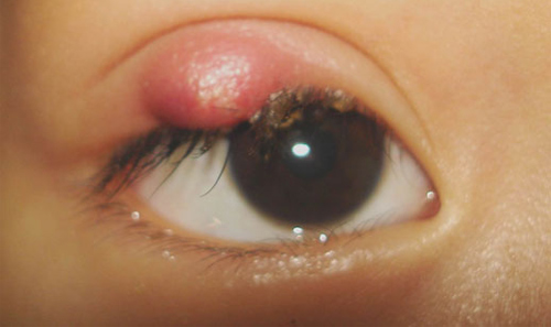 Bệnh Khối u ổ mắt: Nguyên nhân, biến chứng và cách điều trị
