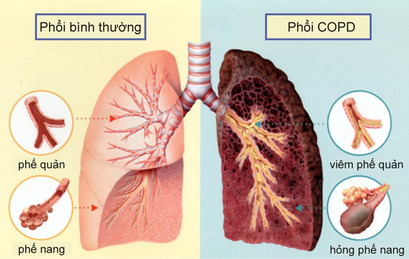 Bệnh Lao phổi: Nguyên nhân, biến chứng và cách điều trị
