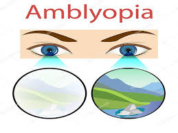 Ảnh 1 của Amblyopia