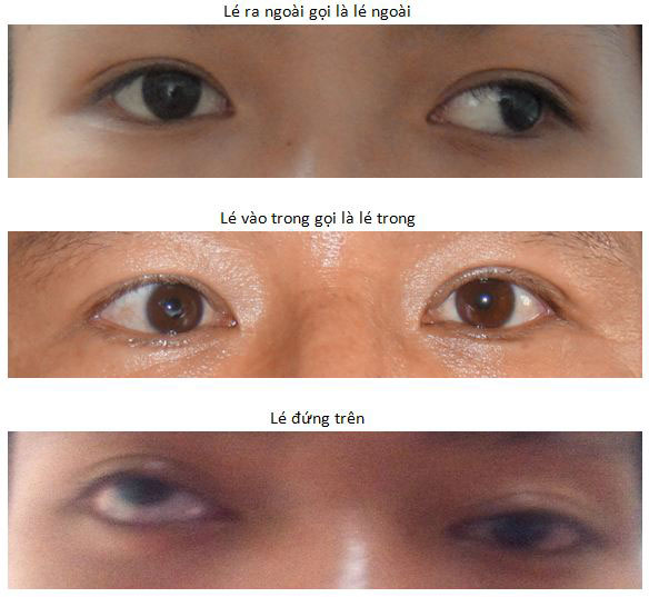 Bệnh Lác mắt: Nguyên nhân, biến chứng và cách điều trị