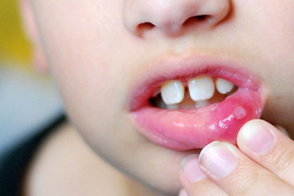 Bệnh Loét miệng: Nguyên nhân, biến chứng và cách điều trị