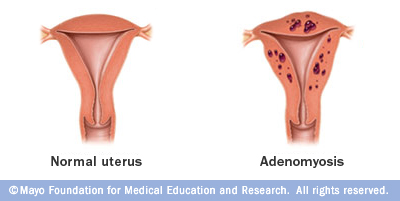 Ảnh 3 của Adenomyosis