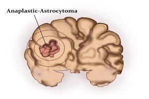 Ảnh 4 của Astrocystoma