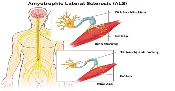 Ảnh 2 của Amyotrophic Lateral Sclerosis