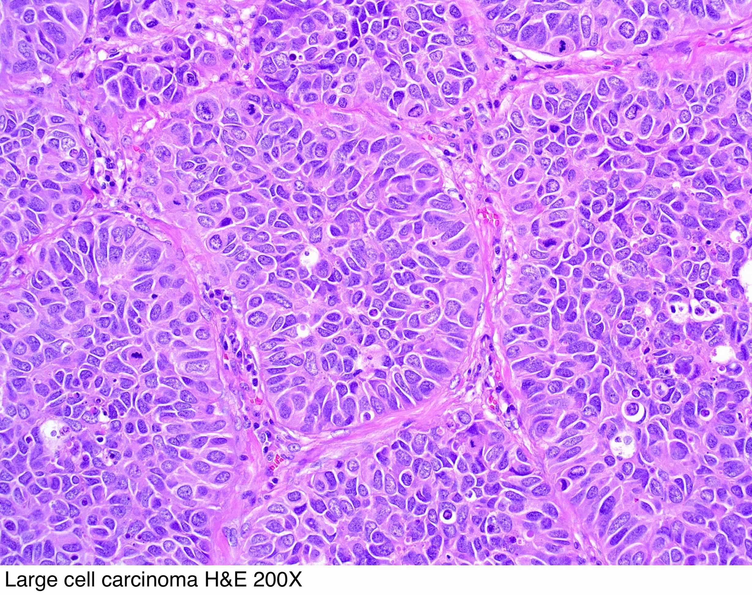 Ảnh 3 của Large cell carcinoma