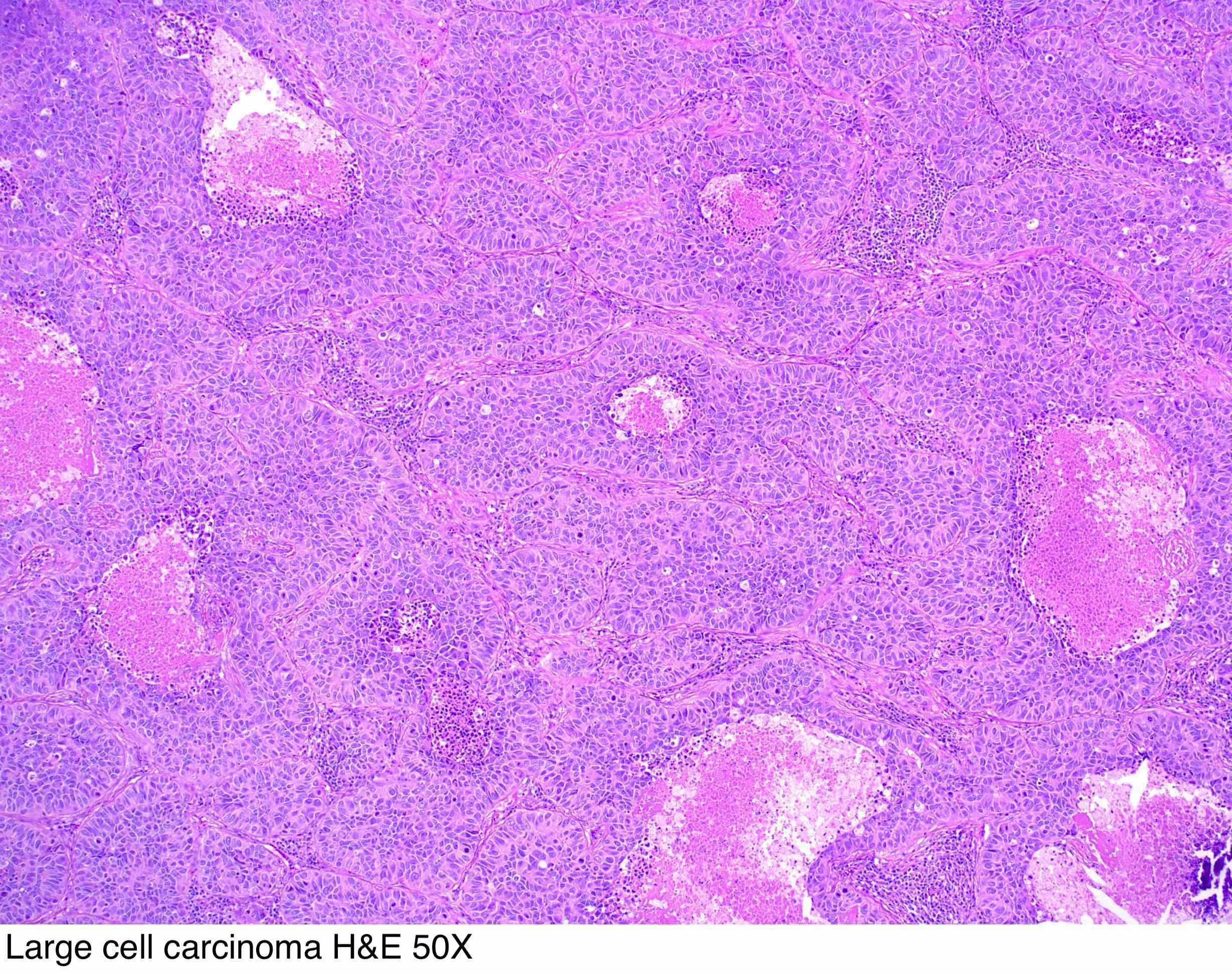 Ảnh 4 của Large cell carcinoma