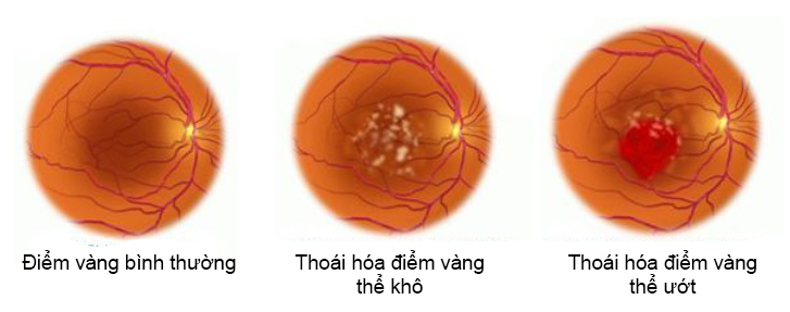 Ảnh 2 của Age-related Macular Degeneration
