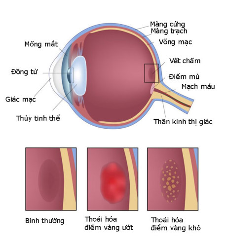Ảnh 1 của Age-related Macular Degeneration