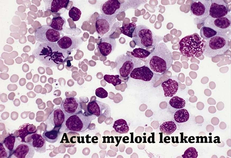 Ảnh 2 của Acute myeloid leukemia (ALL)