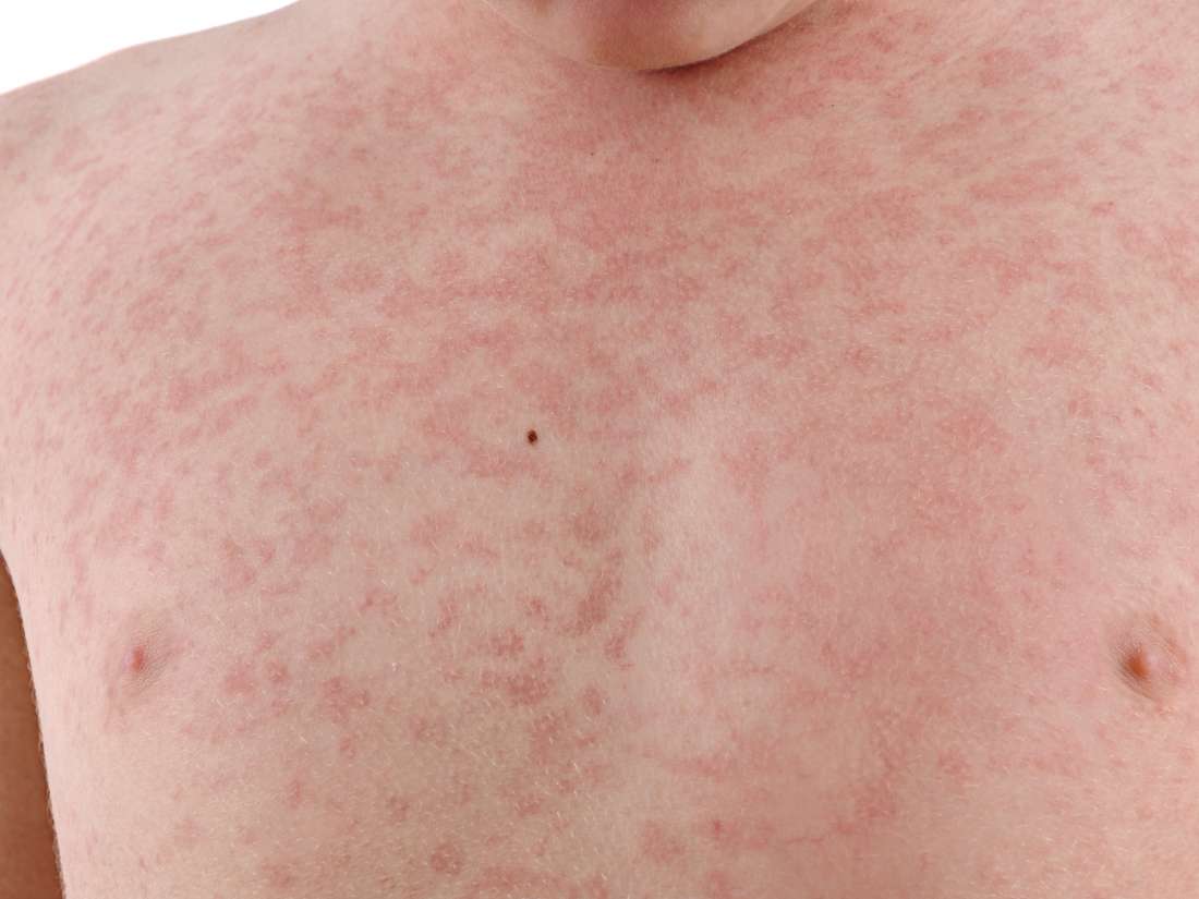 Ảnh 1 của Measles