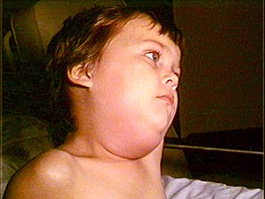 Bệnh Mumps: Nguyên nhân, biến chứng và cách điều trị