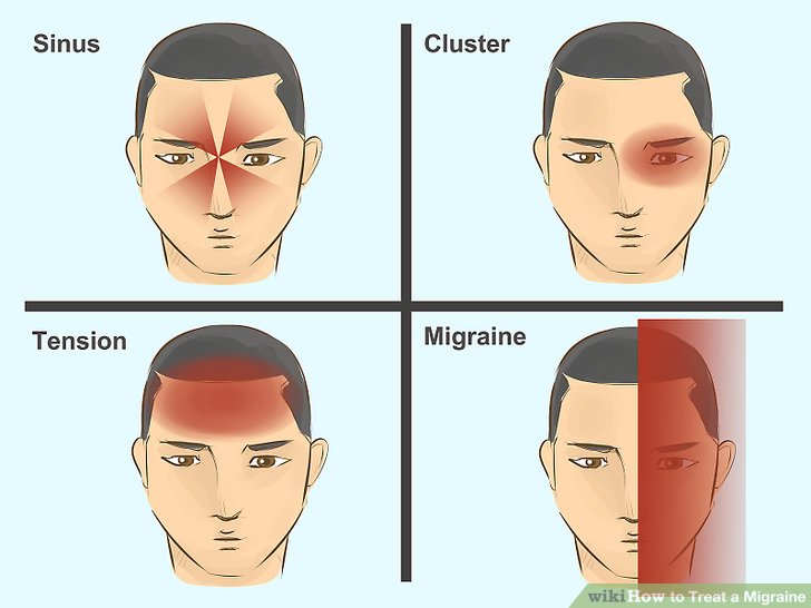 Ảnh 2 của Migraine