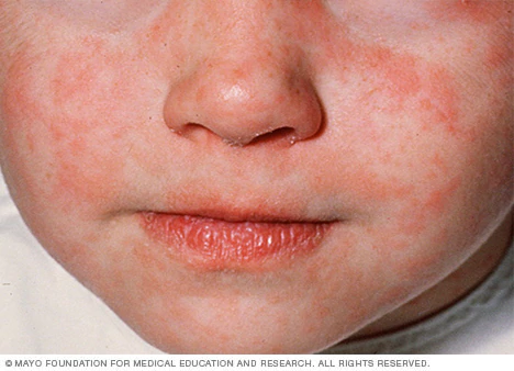 Ảnh 4 của Measles