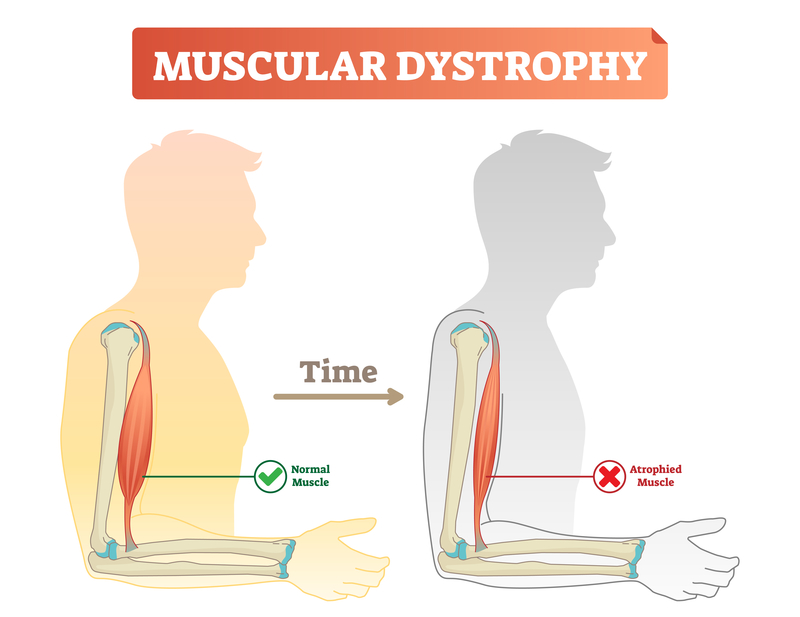 Ảnh 3 của Muscular Dystrophy