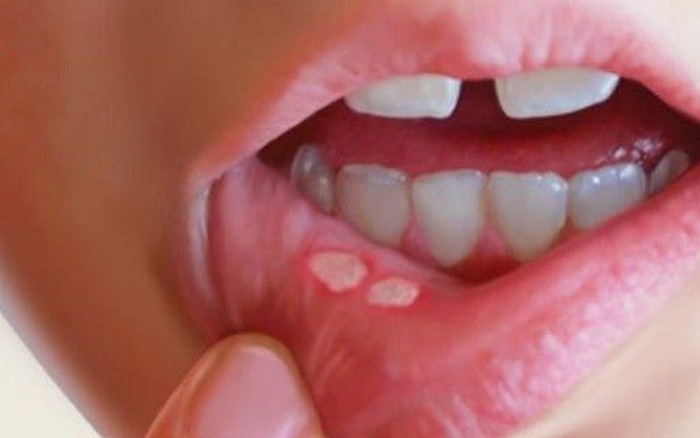 Ảnh 2 của Aphthous ulcers