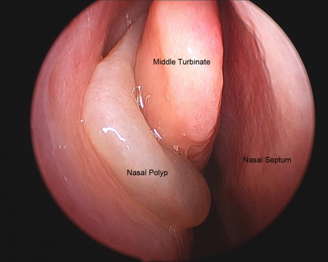 Ảnh 3 của Nasal polyps