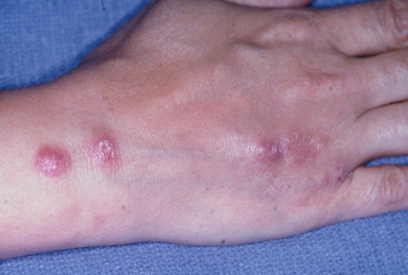 Ảnh 3 của Nấm Mycosis Fungoides