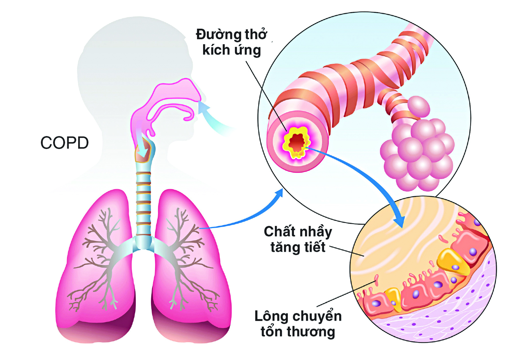Ảnh 1 của Nghẽn mạch phổi
