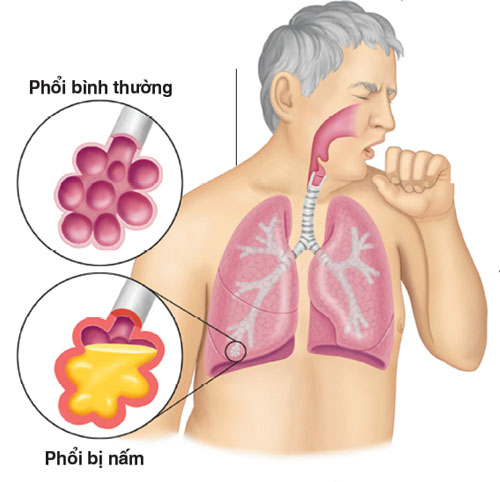 Bệnh Nấm phổi: Nguyên nhân, biến chứng và cách điều trị