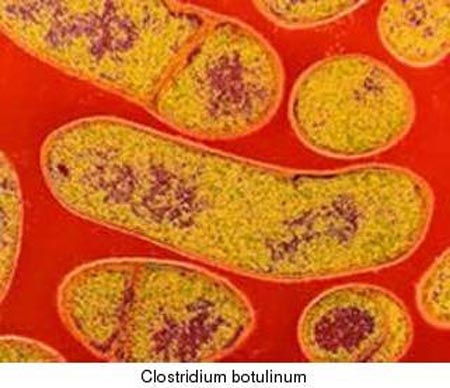 Ảnh 5 của Nhiễm vi khuẩn Clostridium botulinum