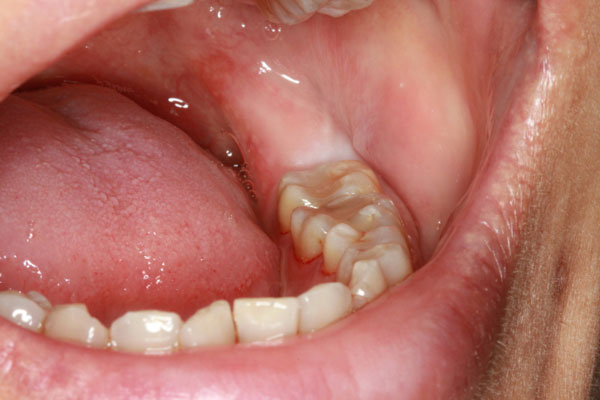 Ảnh 4 của Nhiễm trùng răng