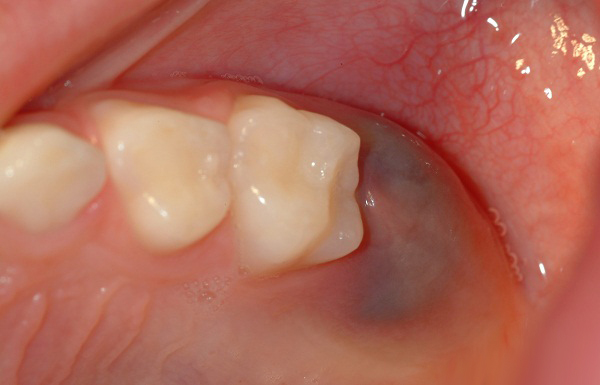 Ảnh 5 của Nhiễm trùng răng