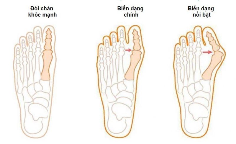 Ảnh 3 của Biến dạng ngón chân cái
