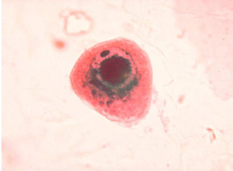 Ảnh 1 của Nhiễm virus Cytomegalo