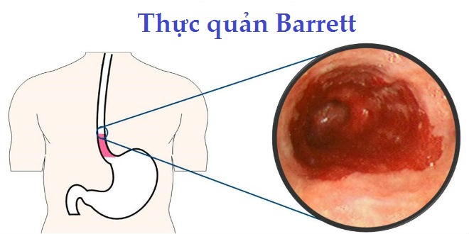 Bệnh Barrett thực quản: Nguyên nhân, biến chứng và cách điều trị