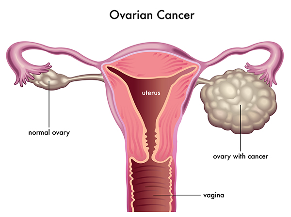 Ảnh 1 của Ovarian cancer
