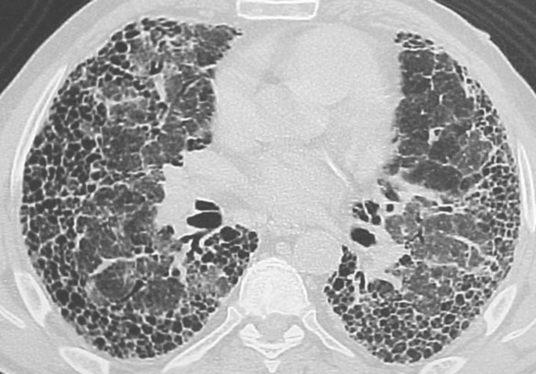 Ảnh 1 của Pulmonary fibrosis
