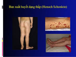 Ảnh 3 của Ban xuất huyết Henoch Schonlein