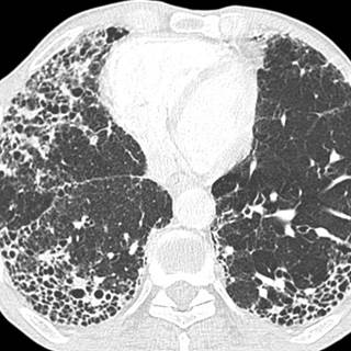 Ảnh 2 của Pulmonary fibrosis