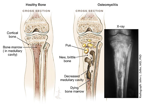 Ảnh 5 của Osteomyelitis