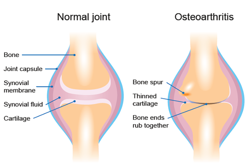 Ảnh 2 của Osteoarthritis