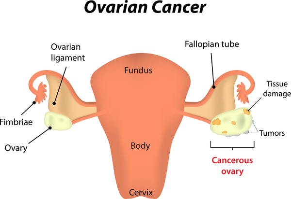 Ảnh 2 của Ovarian cancer
