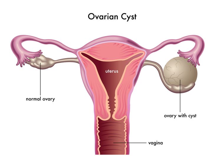 Ảnh 3 của Ovarian Cysts