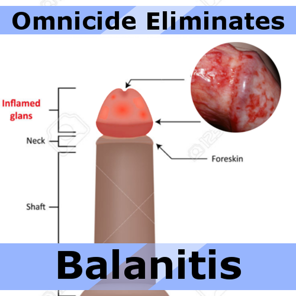 Ảnh 4 của Balanitis