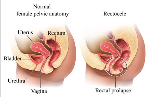 Ảnh 1 của Prolapsed uterus