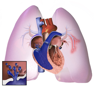 Ảnh 2 của Pulmonary Arterial Hypertension