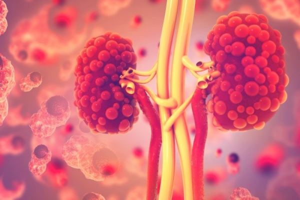 Ảnh 3 của Polycystic Kidney Disease