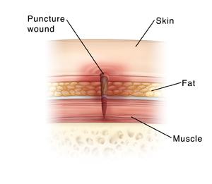 Ảnh 1 của Puncture Wound
