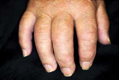 Ảnh 1 của Psoriatic Arthritis
