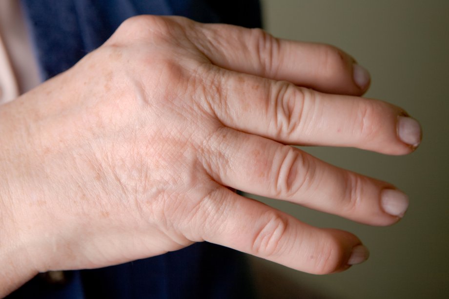 Ảnh 2 của Psoriatic Arthritis