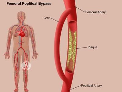 Ảnh 2 của Peripheral arterial disease