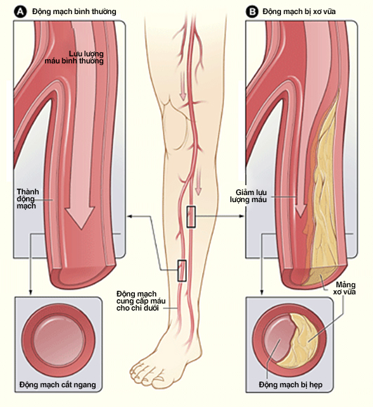 Ảnh 4 của Peripheral arterial disease