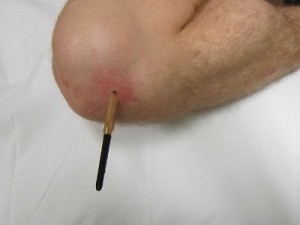Ảnh 5 của Puncture Wound